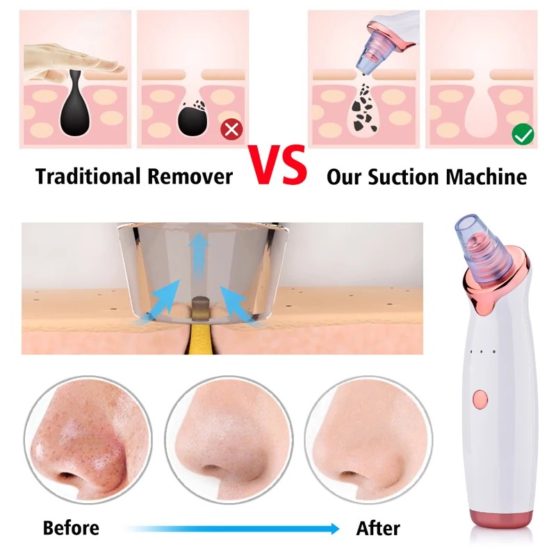 تقنية شفط الفراغ